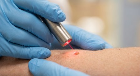 Нежелательные новообразования на коже