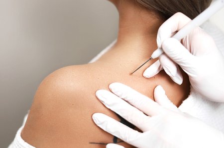 Лазерное удаление новообразований в косметологии